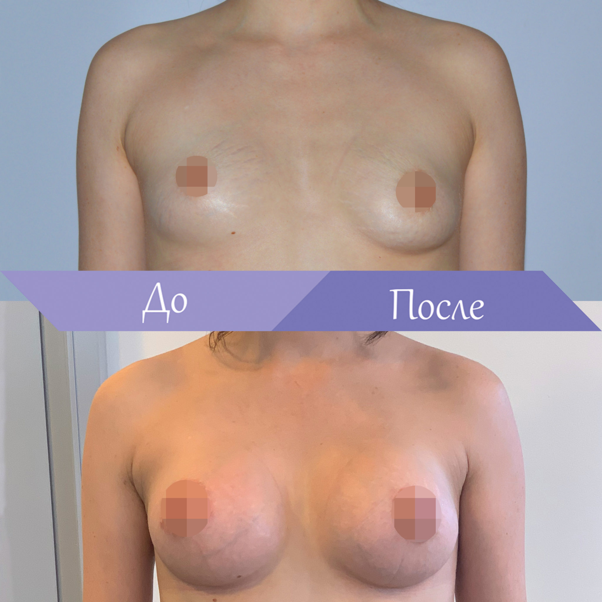 асимметрия груди у женщин форум фото 108